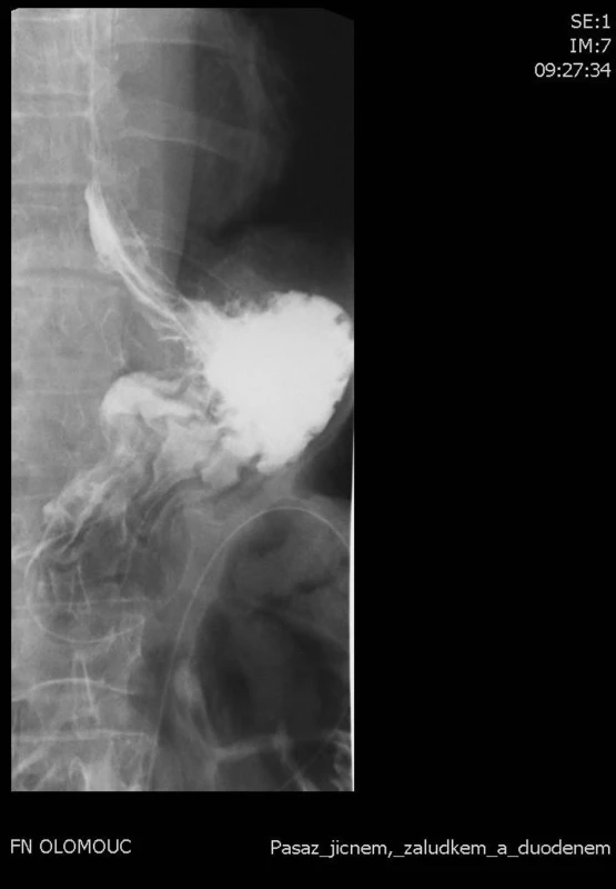 Kontrolní pasáž s vodnou kontrastní látkou 7. pooperační den s příznivým nálezem
Fig. 2: Follow-up swallow with water-based contrast 7. day after operation, good result of examination