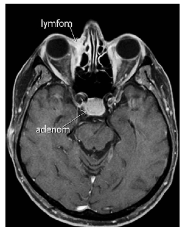 Při kontrolním MRI vyšetření se nezměnila velikost ani charakter intrasellární expanze se suprasellární propagací, zčásti regredovala infiltrace v oblasti etmoidálních sinů vpravo.
