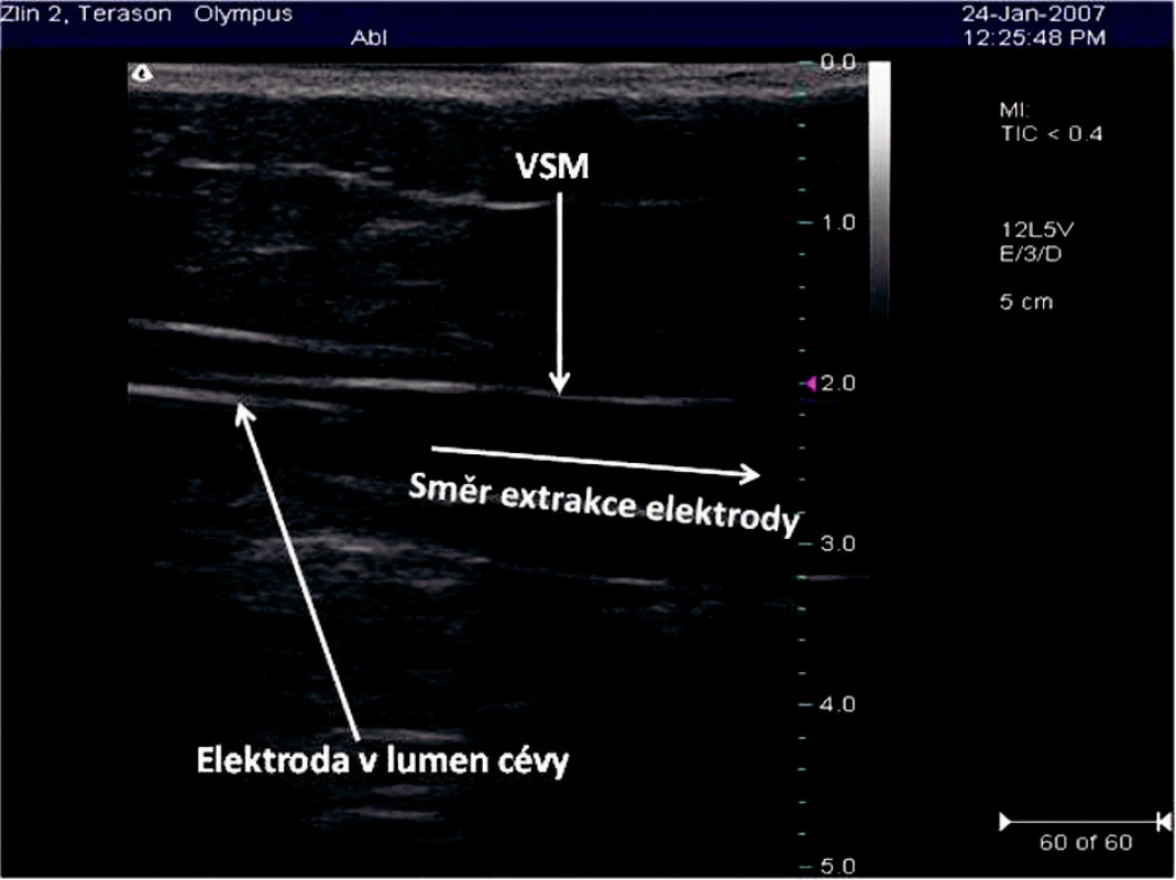 Elektroda RFITT zavedená do VSM v sono obraze
Fig. 3. Ultrasound view of a RFITT electrode introduced info the VSM