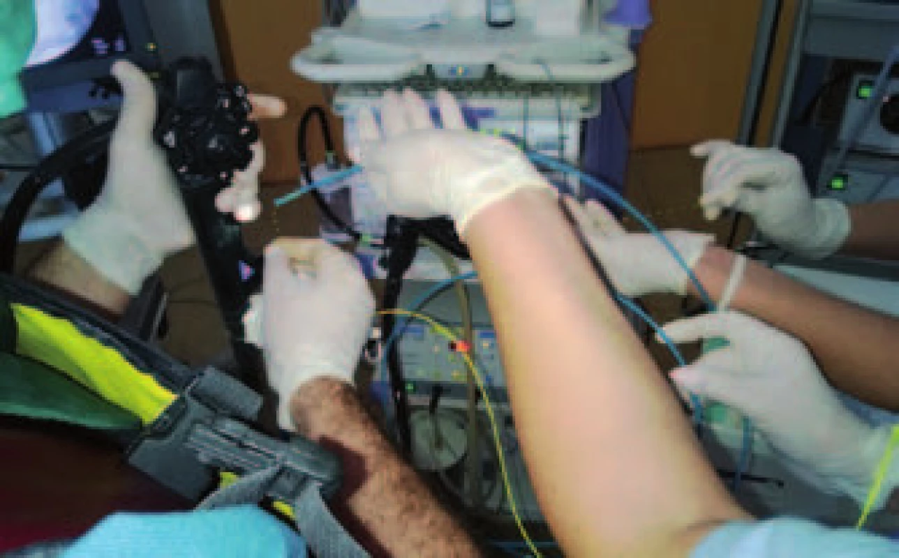 Zavedenie spyskopu (modrá farba) do terapeutického kanála endoskopu.
Fig. 1. Introduction of spyscope (blue) into the terapeutic channel of an endoscope.