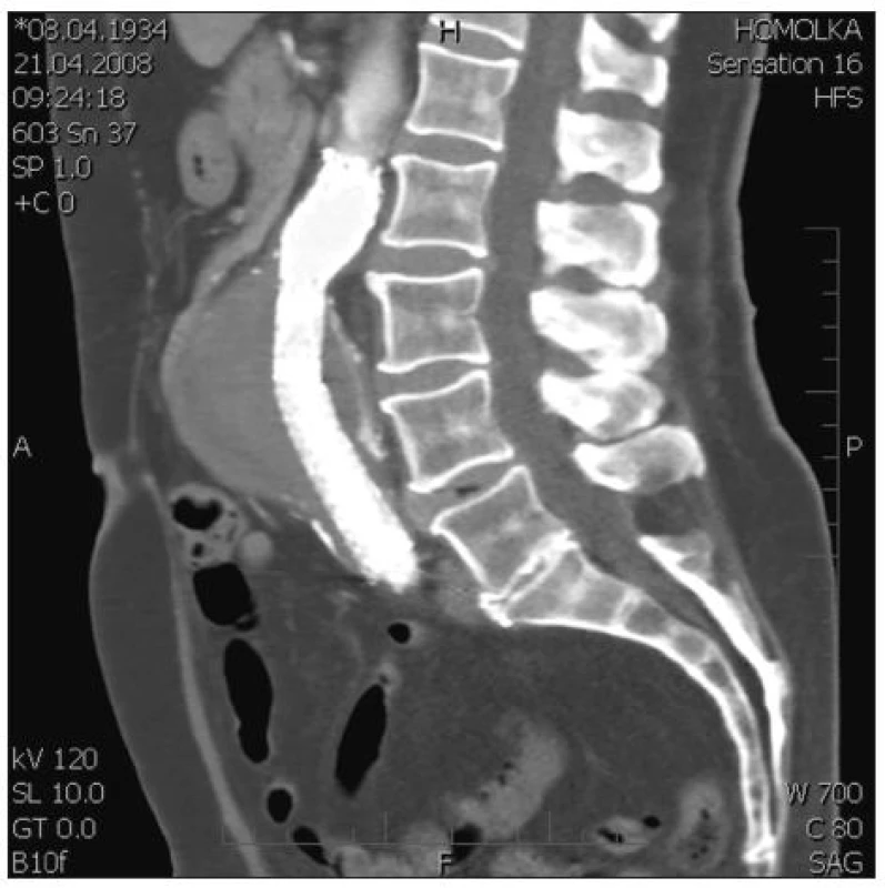 EL při zadní stěně vaku AAA mezi ústími několika aa. lumbales
Fig. 4. EL at the posterior AAA sac wall, between the entrances of several lumbal arteries