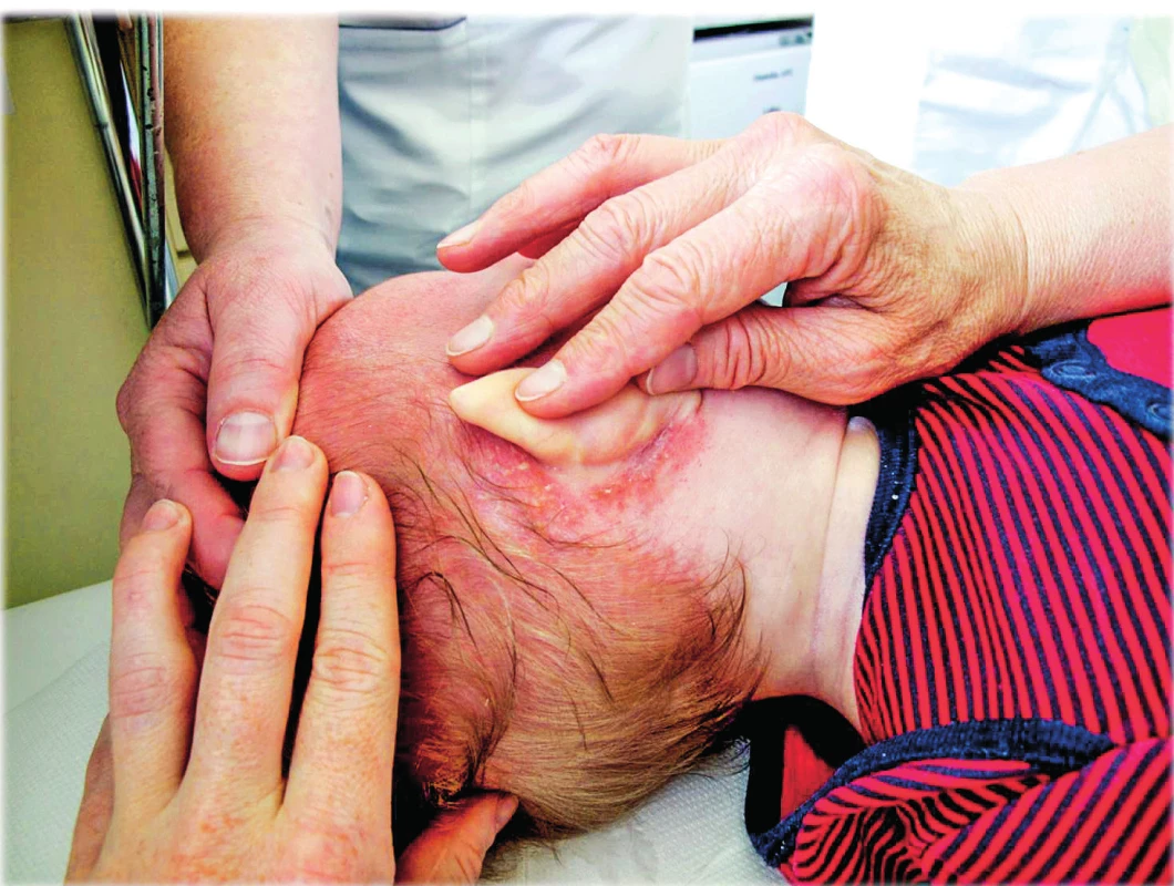 Olupující se dermatitida hnědorůžové barvy za oušky jako projev LCH u 11měsíčního kojence.
Fig. 1. The shelling dermatitis of brown pink colour behind ears as a symptom of Langerhan´s cell histiocytosis in 11-month old infant.