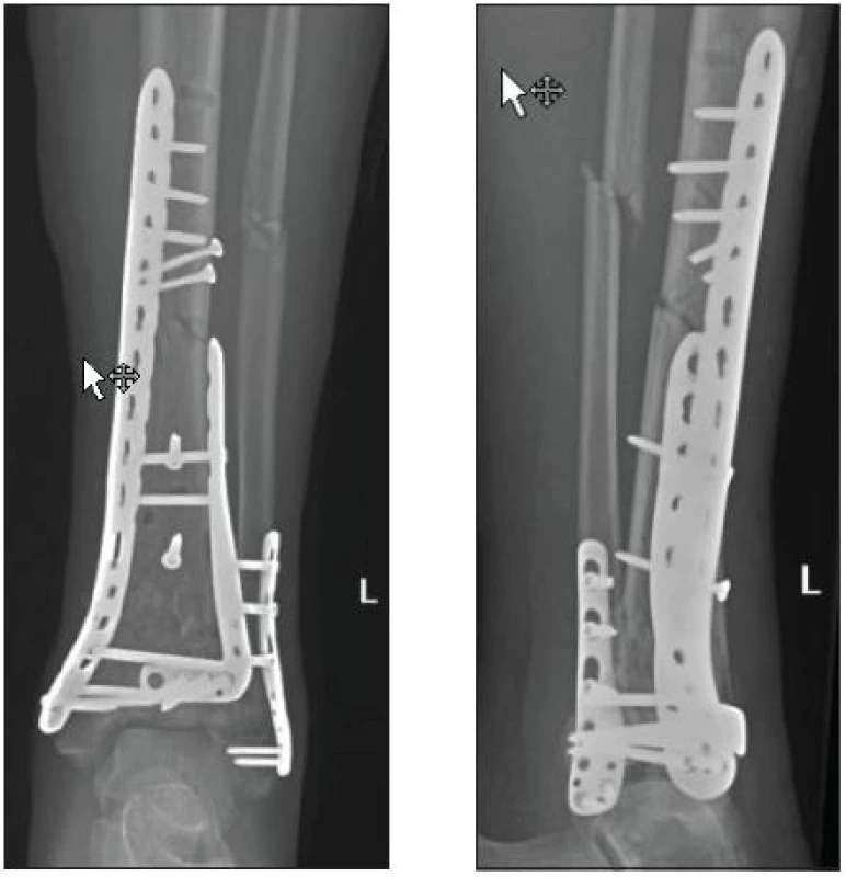 Osteosyntéza fibuly anatomicky tvarovanou dlahou + osteosyntéza tibie anterolaterální a mediální LCP dlahou (KÚCH)