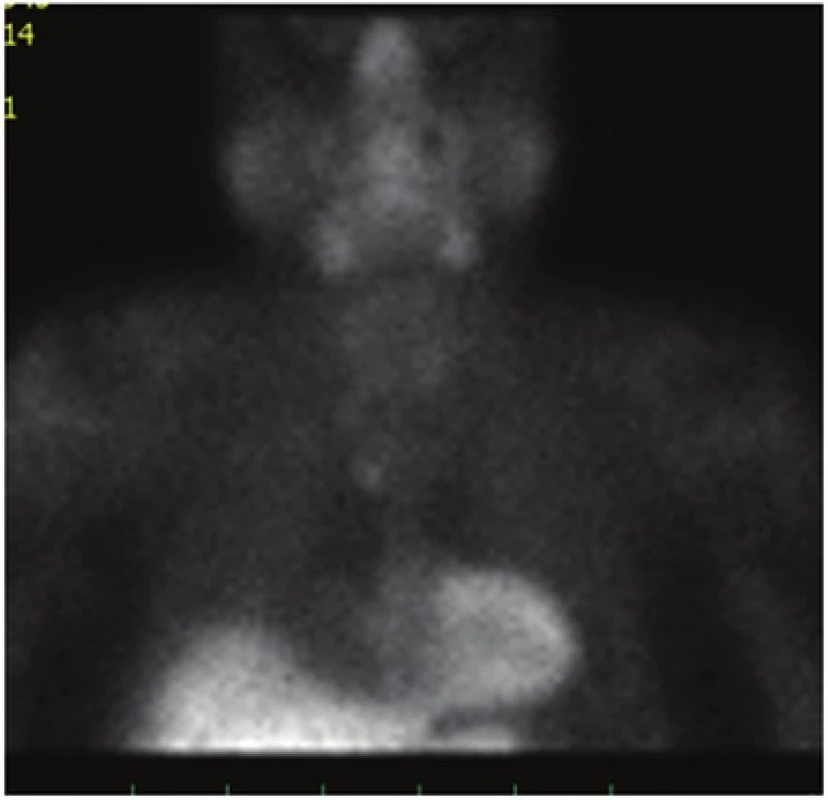 Scintigrafické vyšetření po dvou krčních revizích
Fig. 3: 99mTc MIBI-scintigraphy after two reoperations