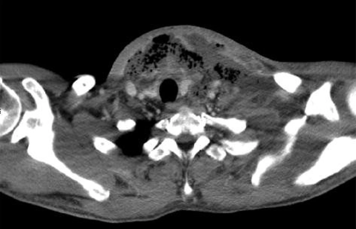 CT obraz – rozsáhlý absces na levé straně a ventrálně na krku
Fig. 2: CT image – a large abscess of the left and ventral part of the neck