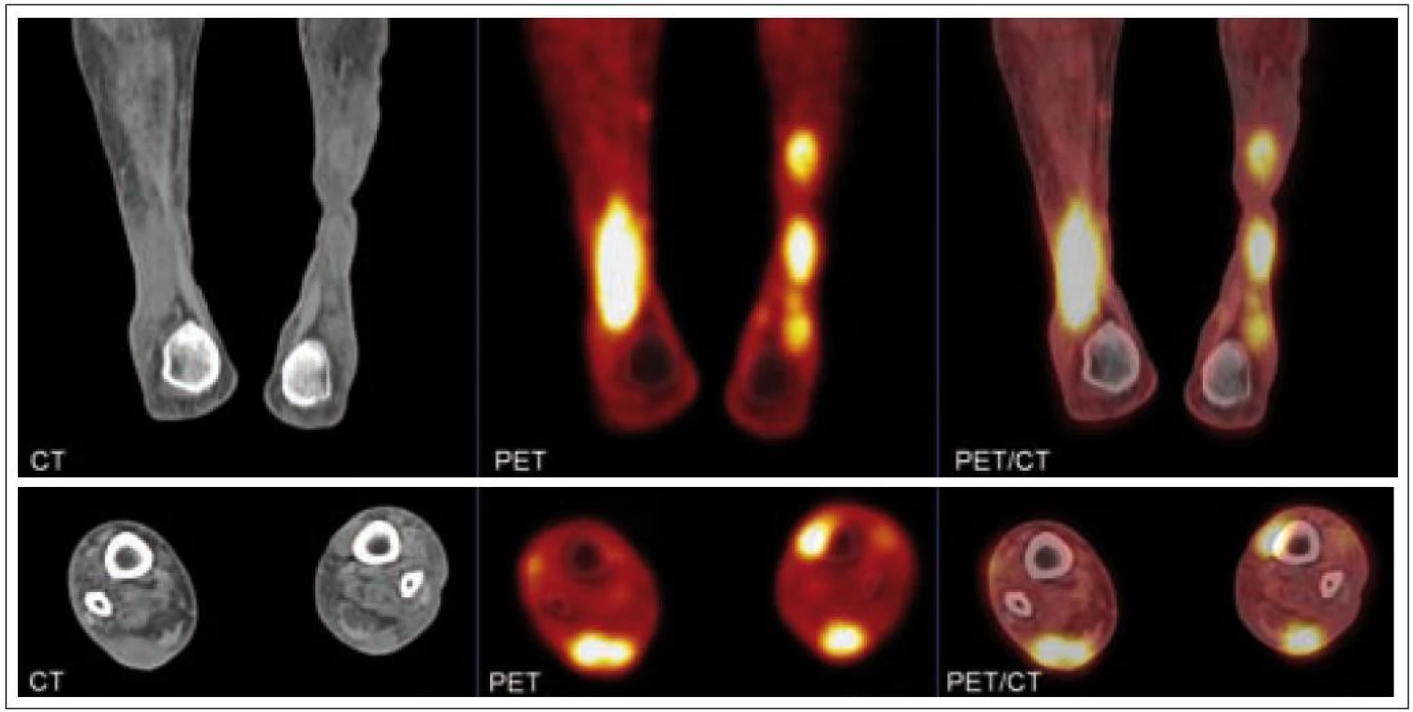 Zobrazení ložisek nekrobiotického xantogranulomu na PET/CT.

Na první sérii zobrazení jsou vidět v koronárním řezu četné infiltráty v distální části obou bérců. Největší infiltrát v distální části pravého bérce dorzálně asi 3,5 × 2 cm, v kraniokaudálním rozměru až 10 cm. Na druhé sérii zobrazení je infiltrát v transverzálním řezu, hloubka největšího infiltrátu je až 2 cm.