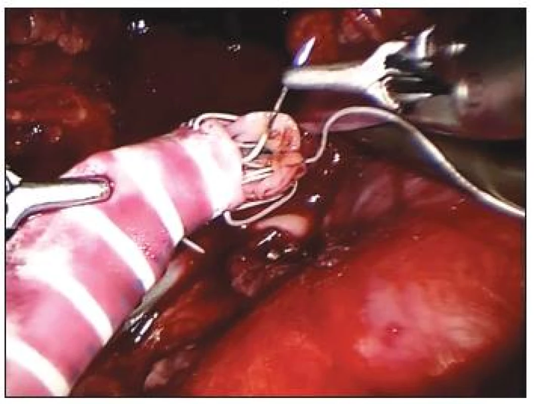 Iliakorenální bypass, anastomóza mezi PTFE protézou a renální tepnou
Fig. 4. Iliaco-renal bypass, anastomosis between the PTFE prosthesis and the renal artery