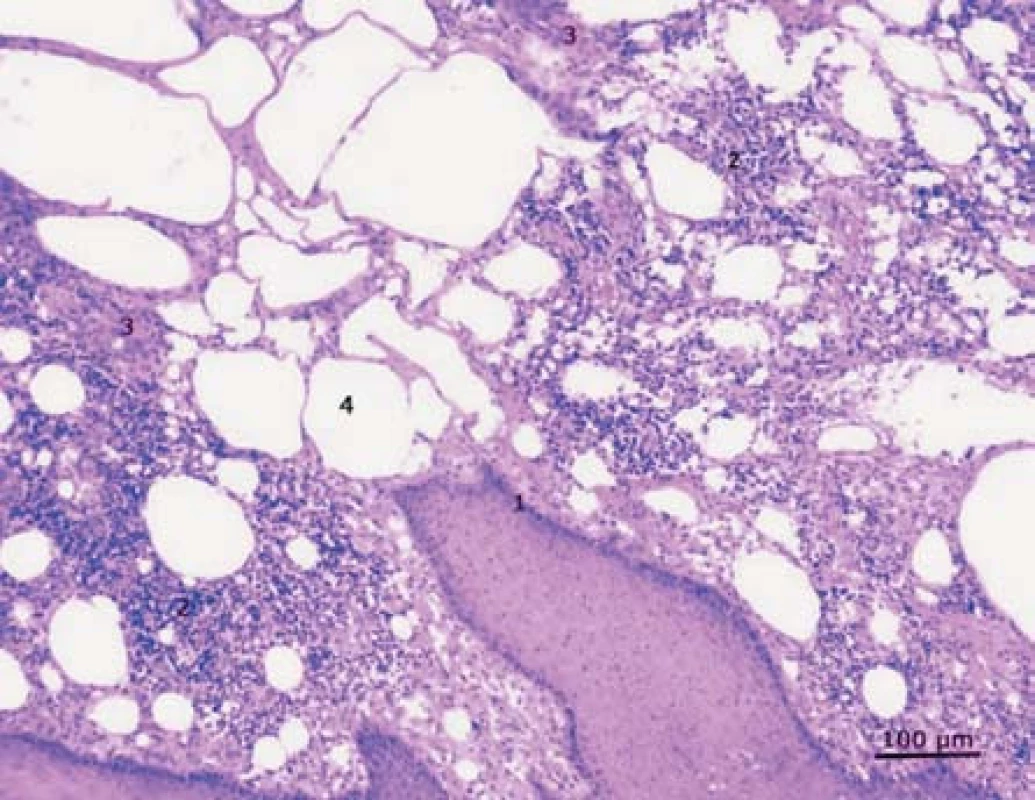 Tkáň prepucia získaná peroperčaně u pacienta po injekční aplikaci borové masti: epidermis (1), lymfocytární infiltrát (2), s četnými makrofágy. Zastiženy také mnohojaderné buňky typu z cizích těles, granulomatózní tkáň (3) a četné tukové vakuoly (4). Barvení hematoxylin-eosin, zvětšeno 100x.
Fig. 5. Tissue of the prepucium obtained peroperatively after the injection aplication of the boric ointment in the past: epidermis (1), lymphocytic infiltrate (2), with macrophages, foreign-body-type multinucleated giant cells, granulation tissue (3) and numerous fat vacuoles (4). Haematoxylin-eosin, magnification 100x