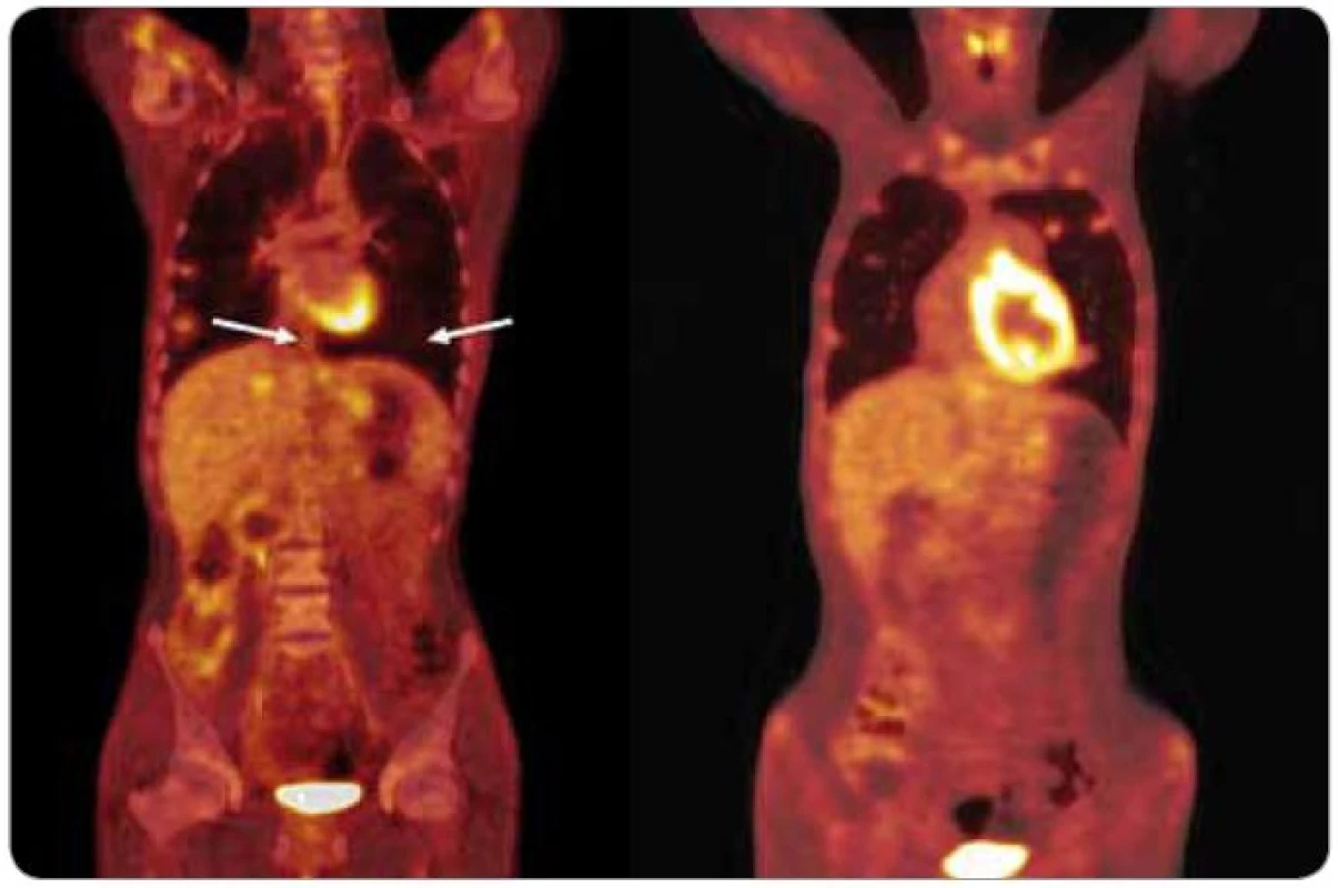 FDG -PET/CT u pacienta s metastatickým choriokarcinomem prokazuje perzistenci viabilní neoplazie v plicích, játrech a retroperitoneu po 4 cyklech chemoterapie BEP.