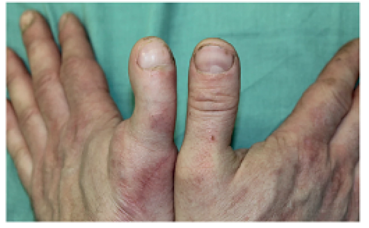 Palec rekonstruovaný prostřednictvím twisted two toes
Fig. 4: Thumb reconstructed using a twisted two toes transfer