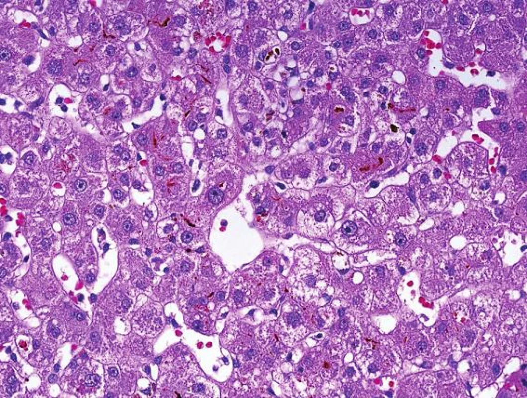 Ischemicko/reperfuzní poškození s metabolickými změnami hepatocytů centrolobulárně. Hepatocyty jsou zduřelé s mikrokapénkovou steatózou a s intracelulární i intrakanalikulární cholestázou (HE, objektiv 40x).