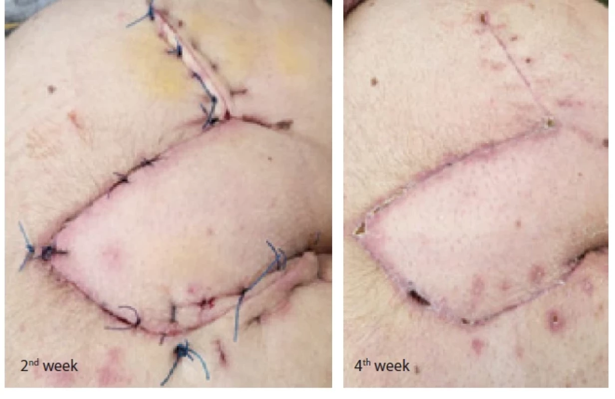 Follow-up at 2nd and 4th weeks postoperatively.