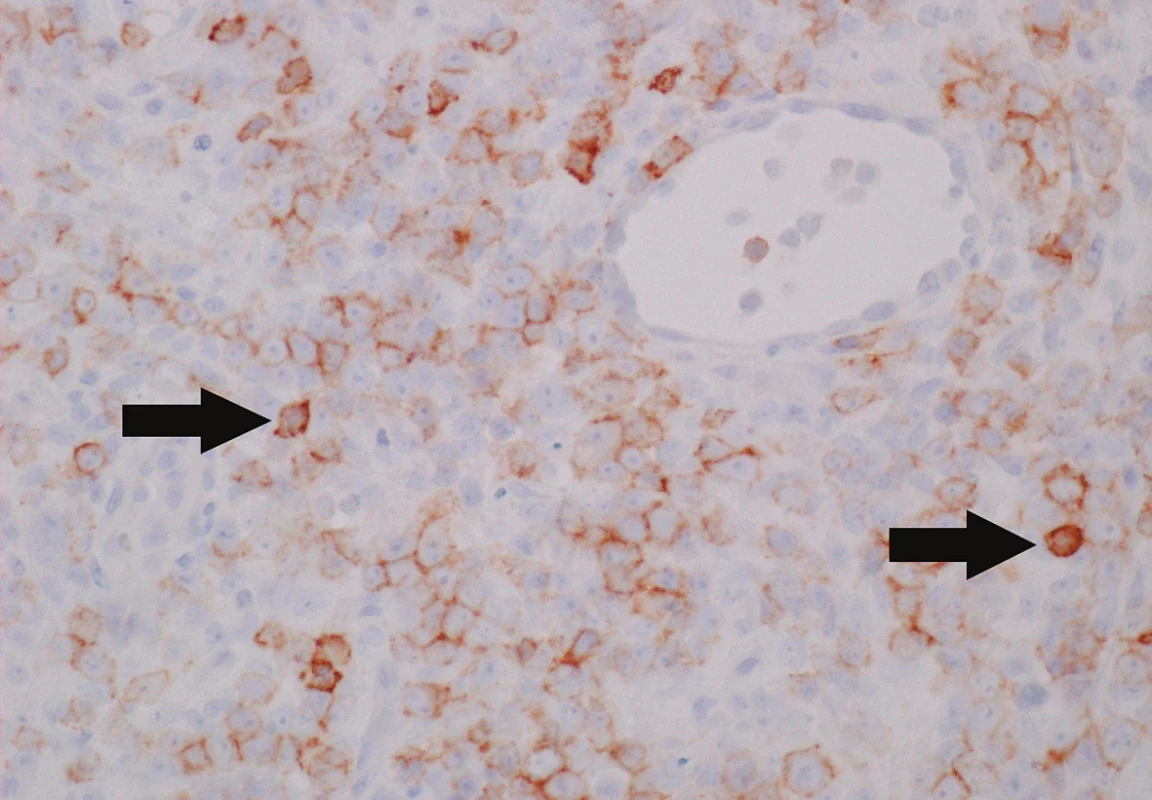 Některé nádorové buňky pozitivní při průkazu antigenu CD56 (šipky) (zvětšení 400krát). Jedná se o imunohistochemické vyšetření.