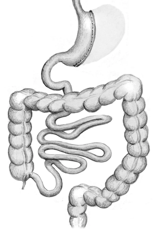 Tubulizace žaludku – sleeve gastrectomy
Fig. 3: Sleeve gastrectomy