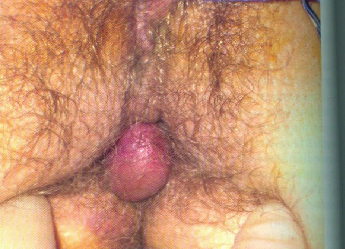 Anální trombóza
Fig. 1: Anal thrombosis