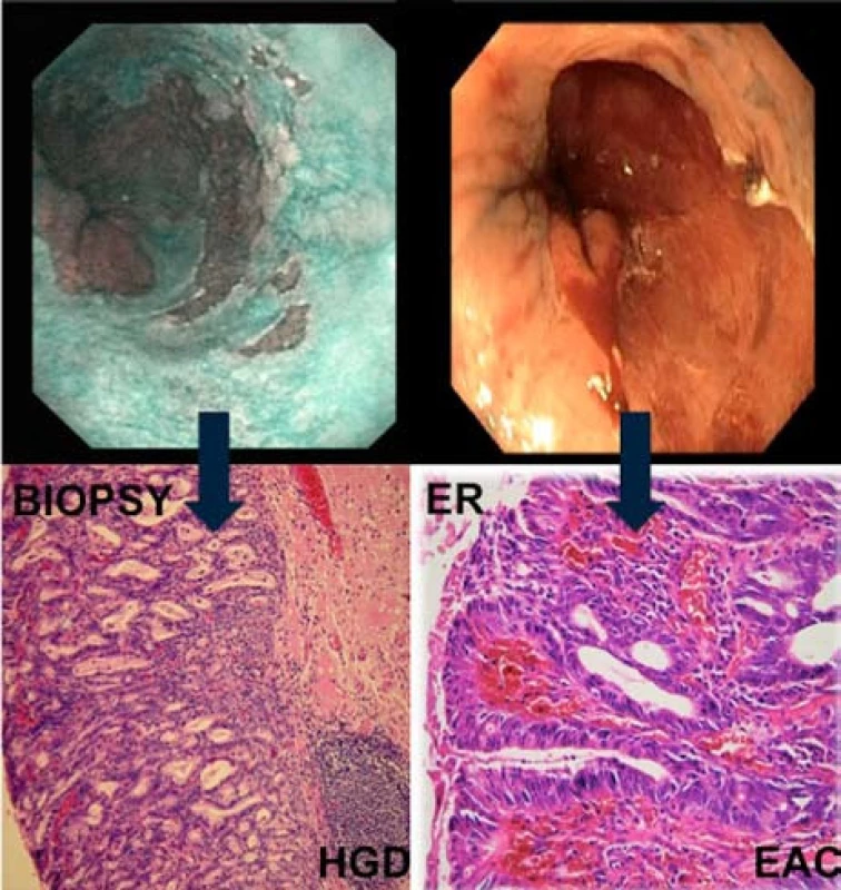 Patologická léze 0-IIb dle Pařížské klasifikace s HGD v biopsiích. Ve vzorku z ER byl potvrzený časný adenokarcinom s hlubokou slizniční invazí.
Fig. 8. Flat lesion 0-IIb with HGD on biopsy and EAC in ER specimen.
