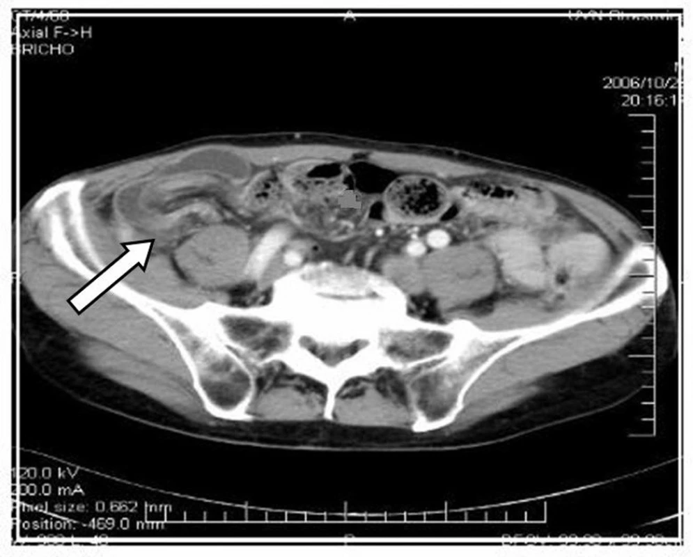 CT: Ileocekální invaginace
Fig. 2. CT: Ileocoecal invagination