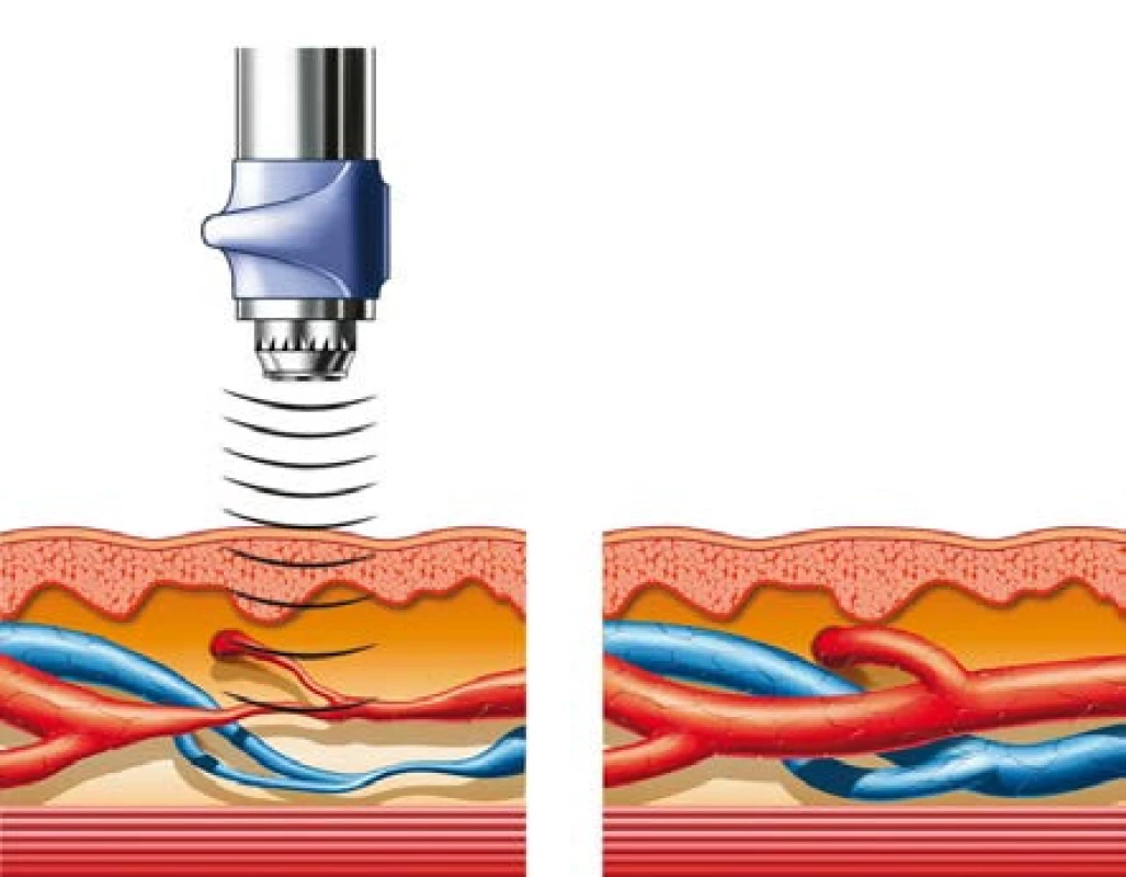 Neovaskularizace
Fig. 2. Neovascularisation