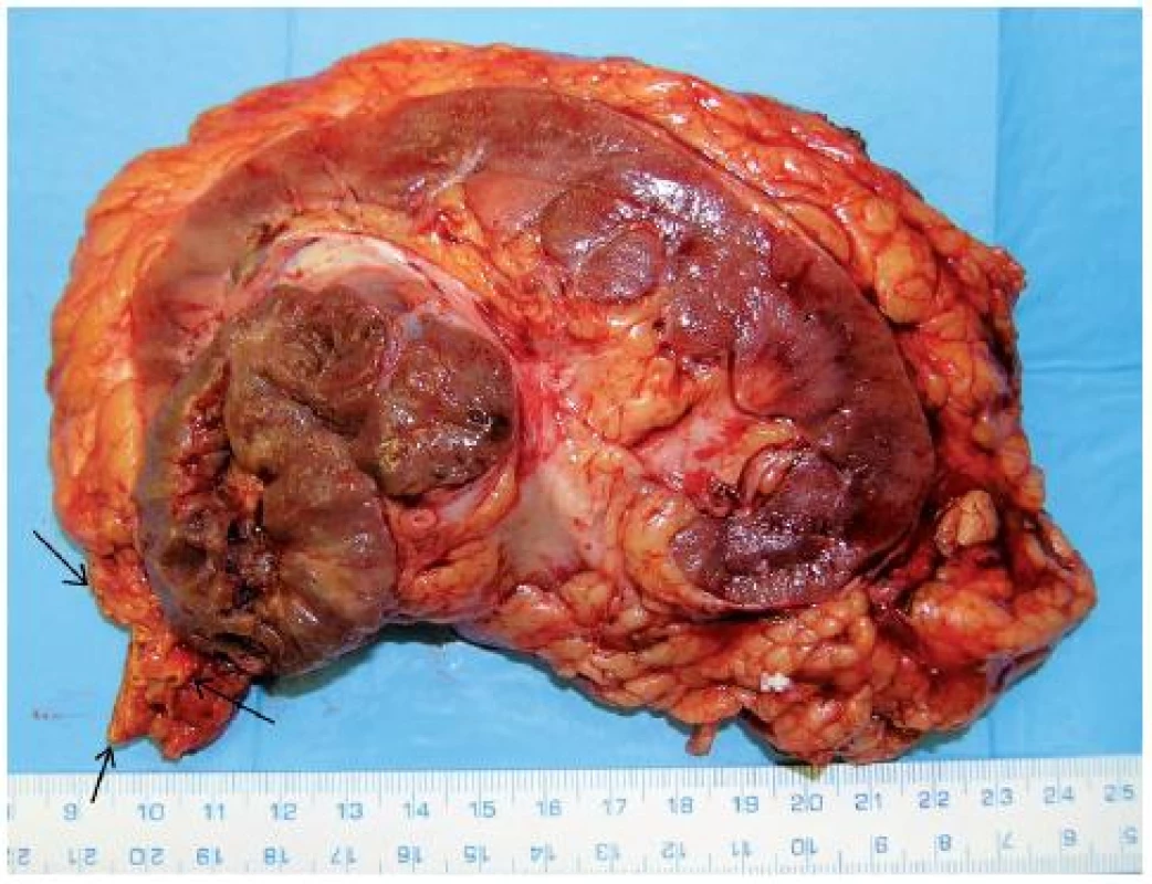 Onkocytický papilární renální karcinom (21) horního pólu pravé ledviny T3aN0M0 u 76letého muže, provedena nefrektomie s adrenalektomií (tumor naléhal na nadledvinu – na preparátu nadledvina označena šipkou) 
Fig. 7. Oncocytic papillary RCC (21) of upper pole of the right kidney T3aN0M0 in a 76-year-old-man. Nephrectomy with adrenalectomy performed (arrows show adrenal gland related to tumour).