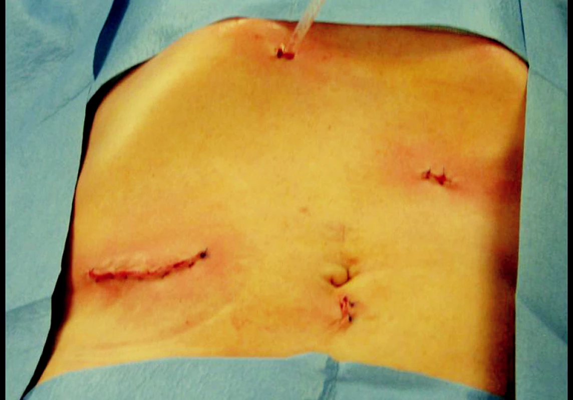 Kosmetický výsledek na konci operace
Fig. 4. Cosmetic outcomes at the end of the procedure