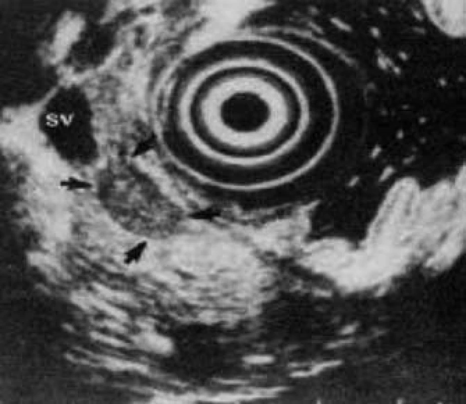 EUS vyšetrenie. Pacient s TU pankreasu (šípka) v oblasti tela. SV – splenic vein – lienálna véna [23].
Fig. 6. EUS examination. Patient with TU in the pancreas (arrow). SV – splenic vein [23].