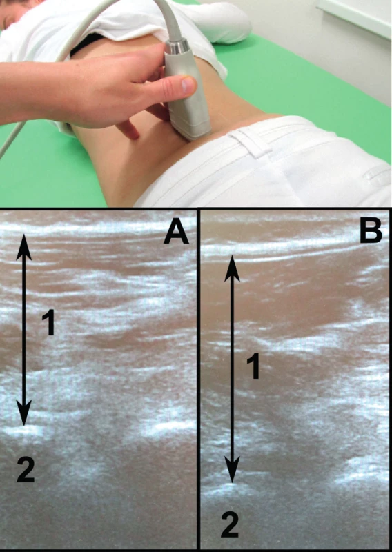 Nahoře poloha sondy při měření tloušťky musculus multifidus, dole odpovídající sonografický obraz se zachycením tloušťky musculus multifidus (1) a facetového kloubu L4/L5 (2) v klidu (A) a při zátěži (B).