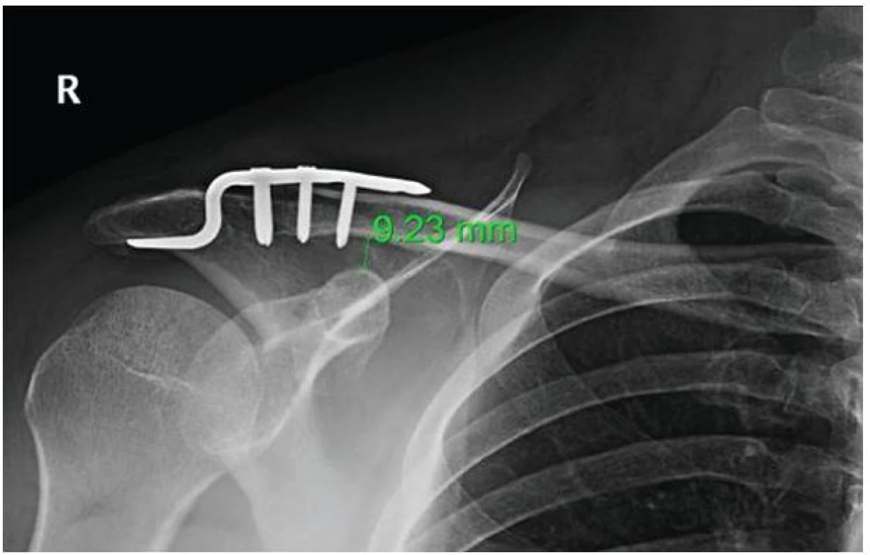 Výsledný stav po stabilizaci háčkovou dlahou, C-C vzdálenost v normě
Fig. 2: Result after hook plate stabilisation, normal C-C distance