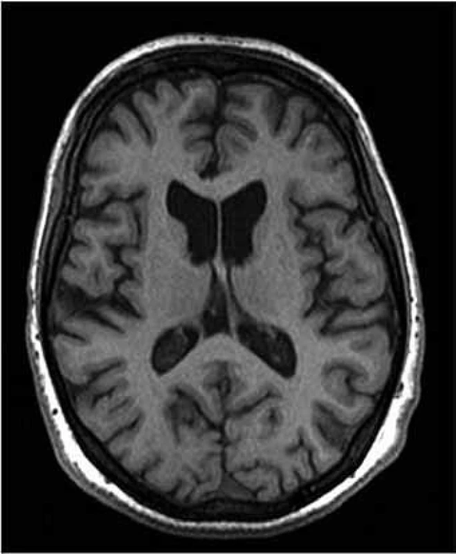 MR obraz atrofie caput nuclei caudati u HN oproti zdravému mozku.
a) zdravý člověk, b) nemocný člověk (Zapůjčeno prof. MUDr. J. Vymazalem, DrSc., oddělení MR, Nemocnice Na Homolce, Praha.)