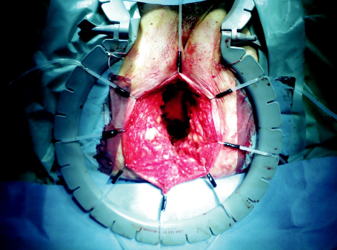 Defekt v oblasti perinea
Fig. 2. Perineal defekt