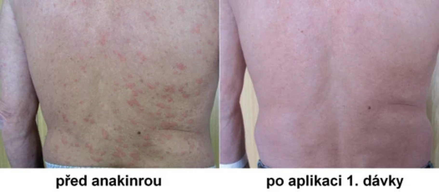 Snímek pacienta s kopřivkovými morfami a jejich vymizení po první aplikaci anakinry.