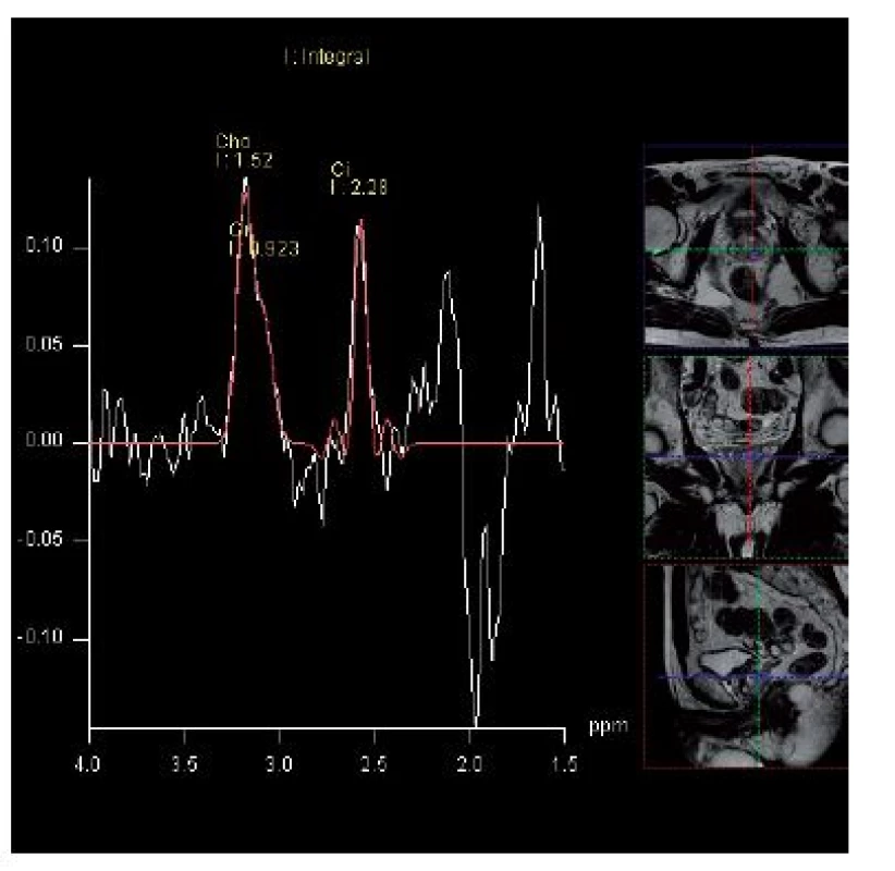 MR spektroskopie – elevace hladiny cholinu a pokles citrátu v levém laloku prostaty
Fig. 2. MRI spectroscopy – elevation of choline level with a decrease in citrate level is the spectral signature of prostate cancer in the left lobe