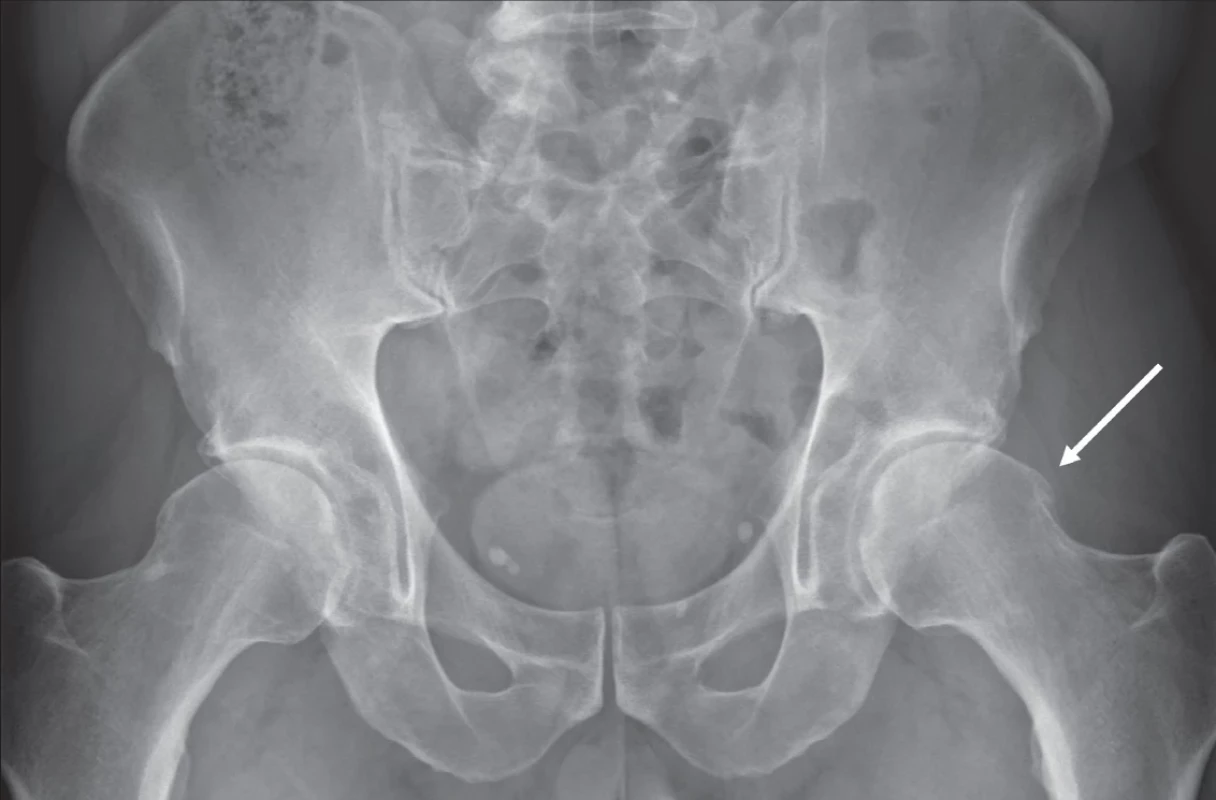  Nativní skiagram pánve, AP projekce, vlevo naznačena laterální CAM  léze (bílá šipka). Fig. 7. Plain X-ray of the pelvis, AP projection, where a subtle lateral CAM lesion  can be seen on the left (white arrow)