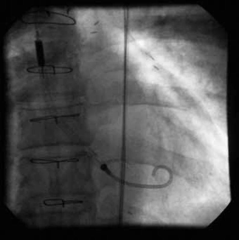 Periprocedurální implantace systému Impella- Recover LP 2.5 (Abio-med, Inc, Danvers, Mass, USA) u 57letého nemocného během komplikované perkutánní koronární intervence na kmeni levé věnčité tepny.