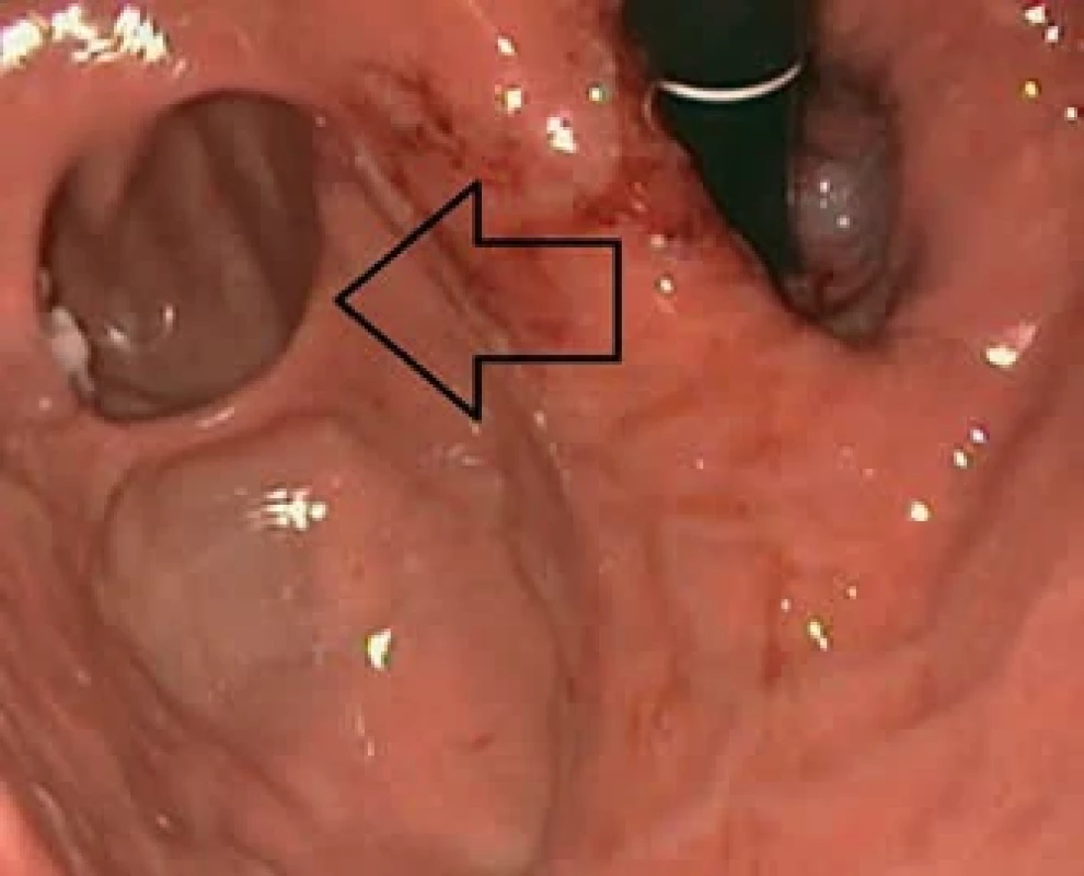 Endoskopický obraz divertiklu fundu žaludku (šipka) z inverzního pohledu. Endoscopic findings of diverticulum in the fundus area of the stomach (arrow) from inverse view.