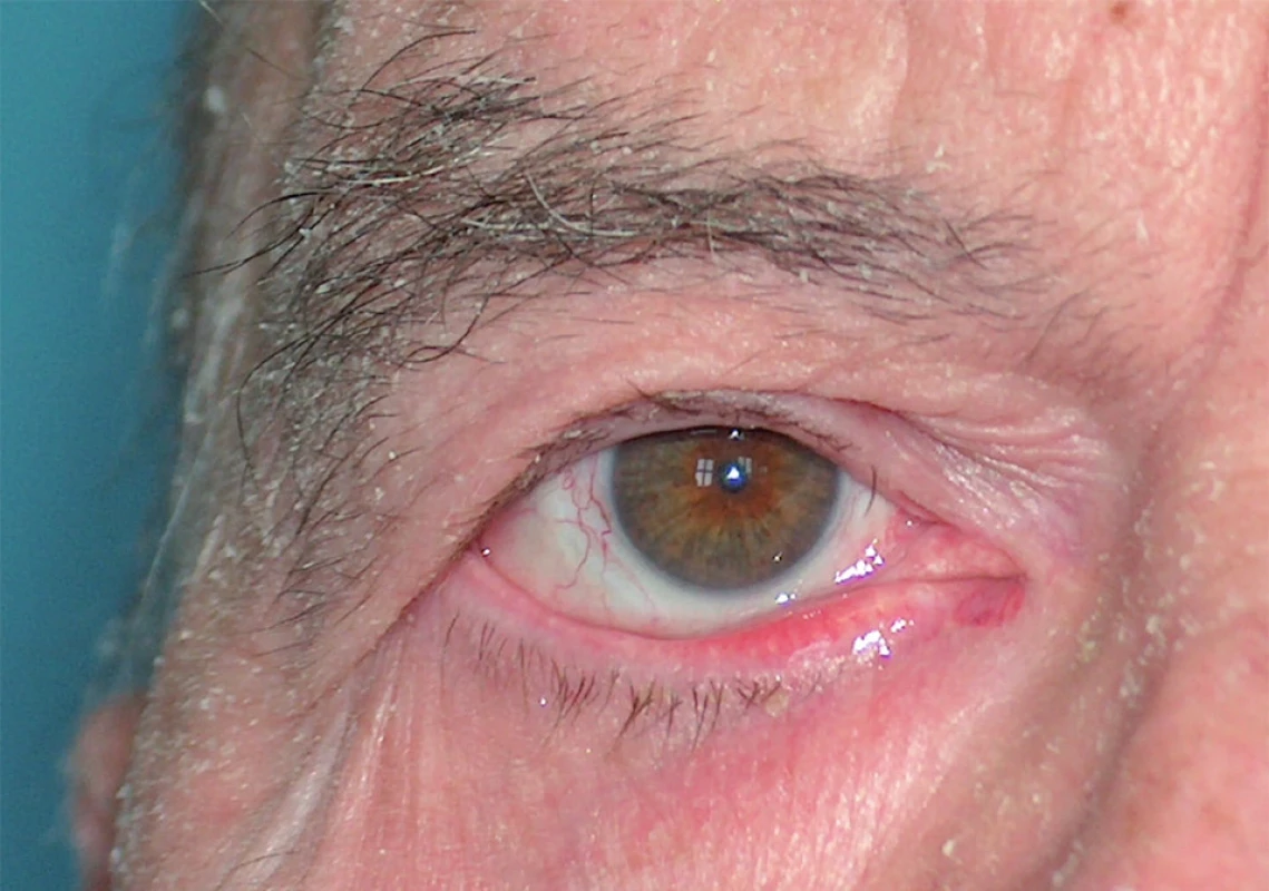 Ektropium