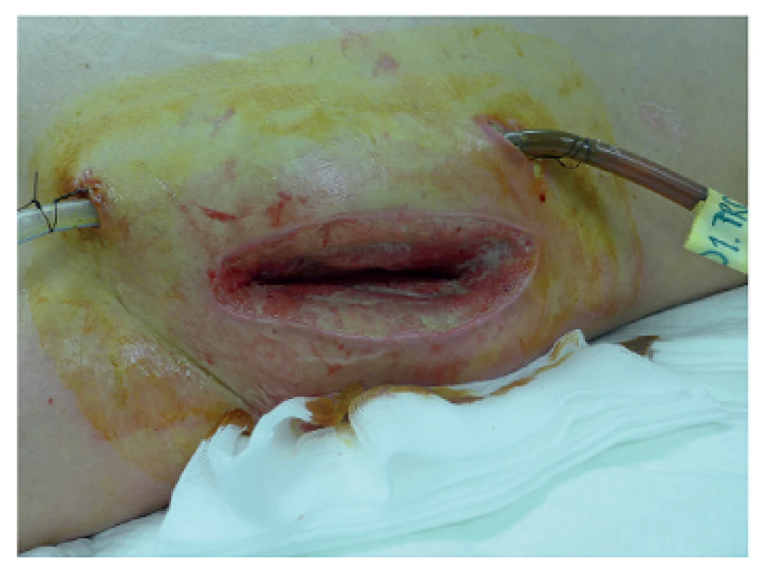 Přístup do retroperitonea z lumbotomie
Fig. 4: Access to the retroperitoneum via lumbotomy