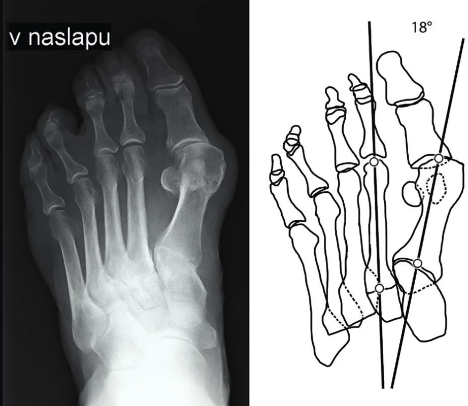 Předozadní rentgenový snímek přednoží s typickou deformitou hallux valgus; schéma měření prvního intermetatarzálního úhlu; úhlu mezi spojnicemi středů kloubních ploch prvního a druhého metatarzu.