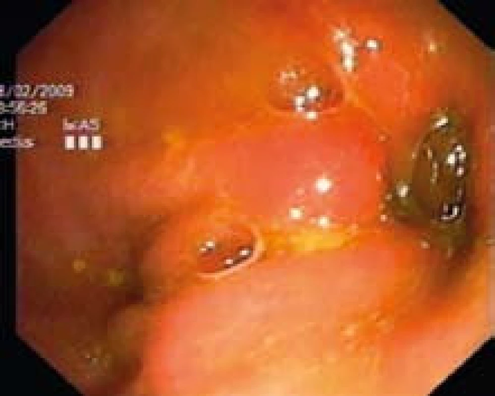 Kolonoskopia: pohľad na pylorus.
Fig. 4. Colonoscopy: view of pylorus.