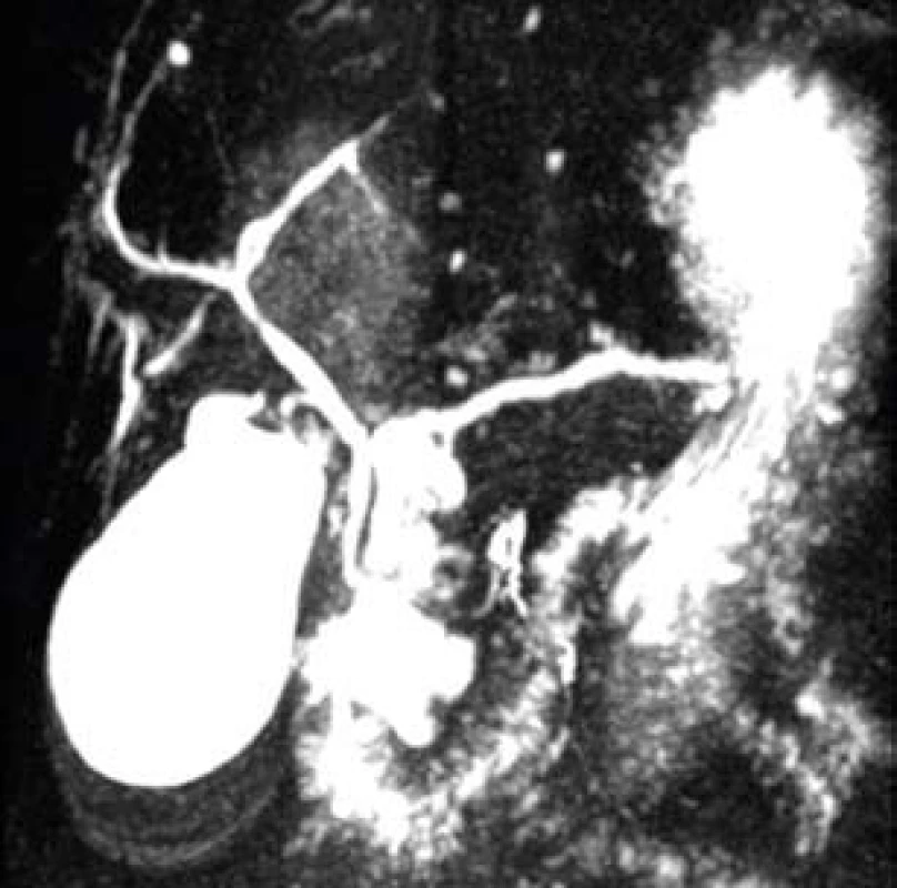 MRC P: cystická lézia v hlave pankreasu bez komunikácie s hlavným pankreatickým vývodom.
Fig. 3. MRCP: cystic lesion in the pancreatic head without communication with main pancreatic duct.