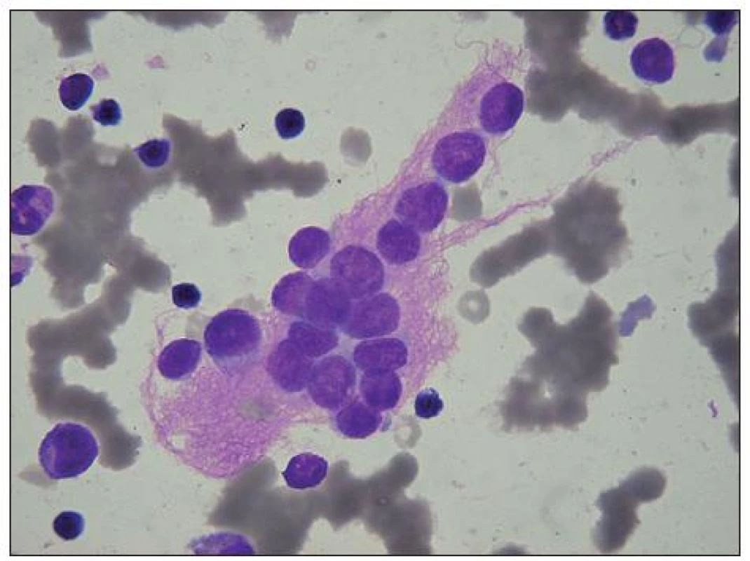 Neuroblastom: velký svazek růžovofialových neurofibril, obklopujících metastázu neuroblastomových buněk
v KD. U některých není patrná cytoplazma. V okolí několik malých lymfocytů, u levého okraje myelocyt, nad ním metamyelocyt (na obrázku četné erytrocyty v rouleaux).