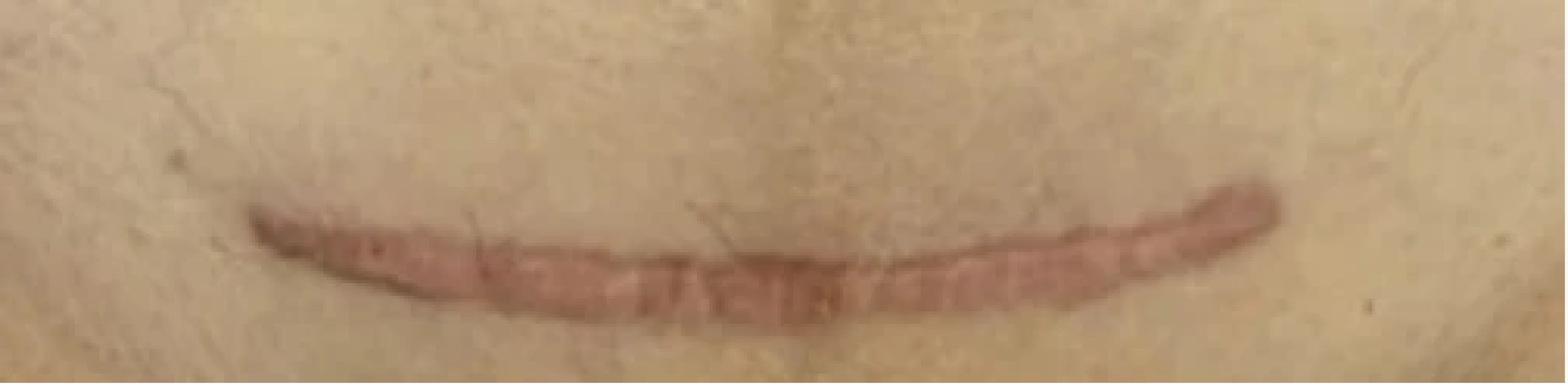Keloidní jizva (v nejširším místě široká 11 mm) 2,5 roku po porodu císařským řezem. Fig. 2. A keloid scar (11 mm wide at its widest point) 2.5 years after a cesarean section.