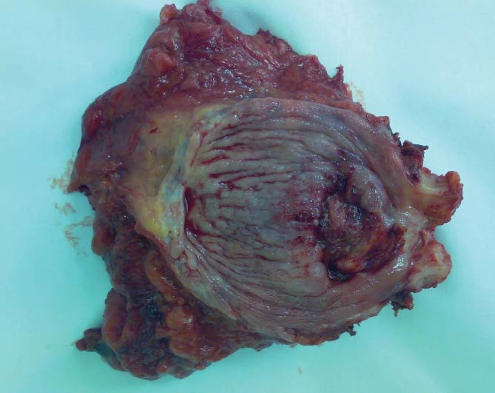 Preparát močového měchýře s tumorem a prostatou (25 g) po Millinově prostatektomii.
