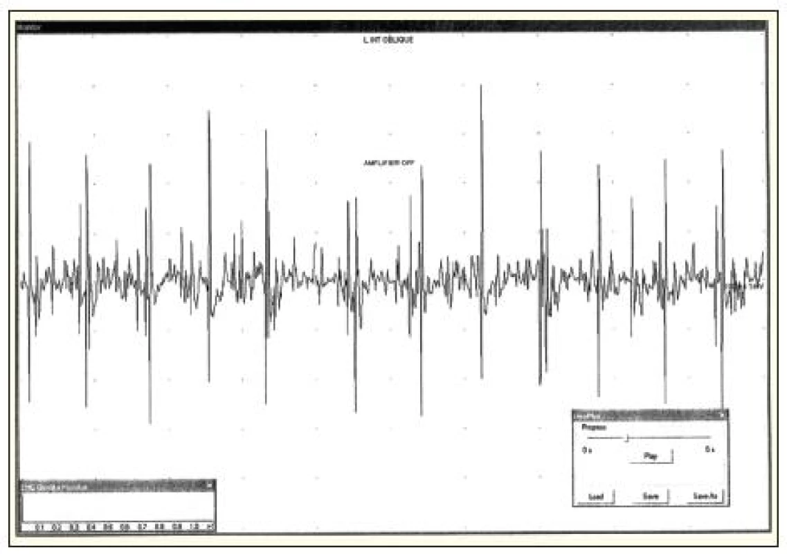 Elektromyografický nález u pacienta s parézou v oblasti pravého dolního břišního kvadrantu. Neurogenní změny v oblasti m. rectus abdominis vpravo.
