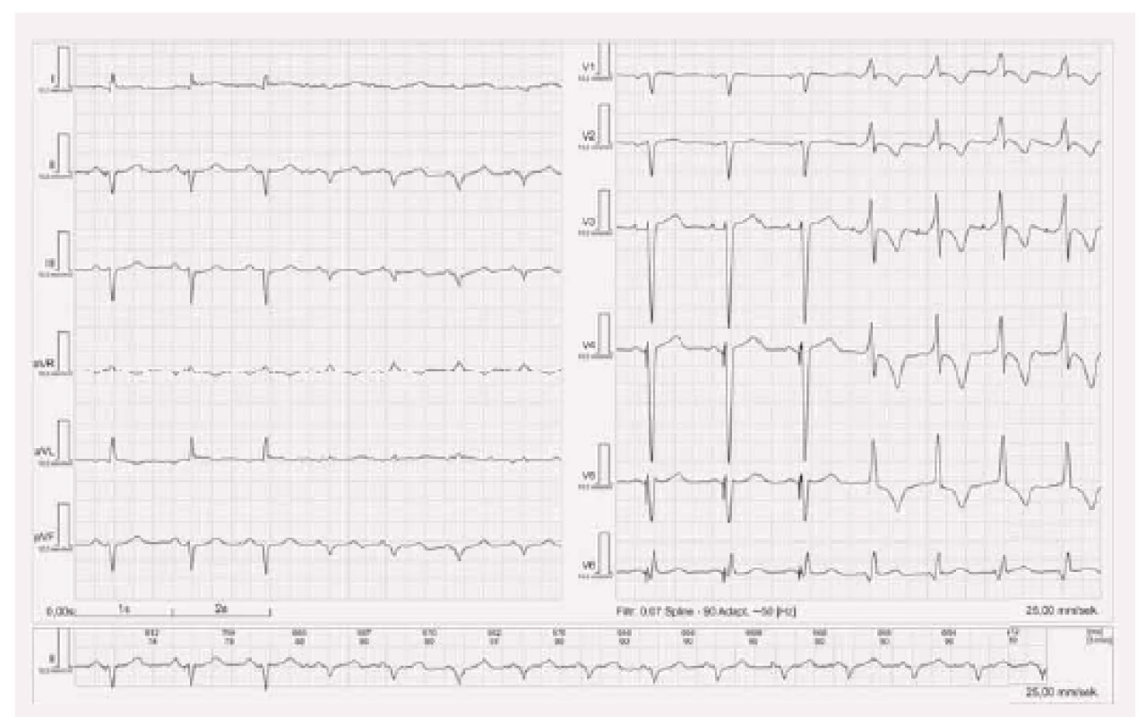 Cardiac memory.