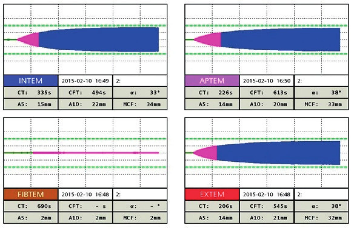 Trombelastogram, vyšetření před terapií, poukazuje na těžkou hypofibrinogenémii
V kanálu FIBTEM vidíme prodloužení CT (cloting time 690 s a hodnoty A5 2 mm a A10 5 mm), což ukazuje na těžkou hypofibrinogenémii, která je pro peripartální život ohrožující krvácení typická.