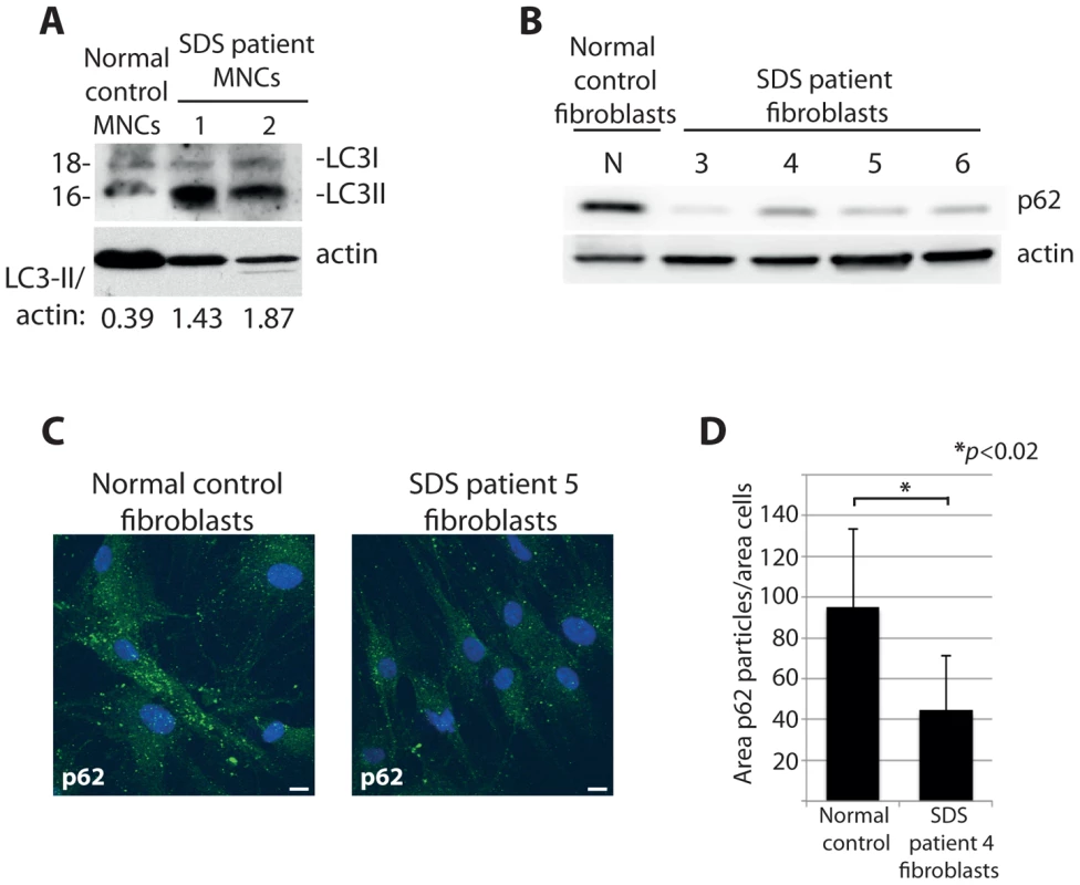 Cells from SDS patients reveal increased autophagy.
