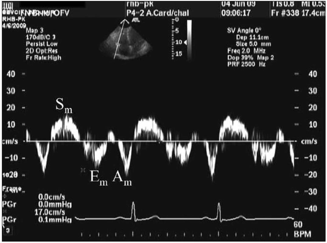Tkáňový Doppler.
S<sub>t</sub> – systolická rychlost, E<sub>t</sub> – časná di astolická rychlost, A<sub>t</sub> – rychlost pohybu myokardu při síňové kontrakci.
