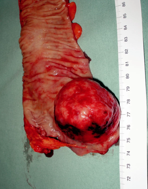 Resekáty rekta a pravé poloviny tračníku: patrny objemné lymfomy, mezokolon vzestupného tračníku masivní infiltrace uzlin
Fig. 3. Specimens with rectal and caecal lymphoma; massive mesenteric lymh node infiltration is remarkable