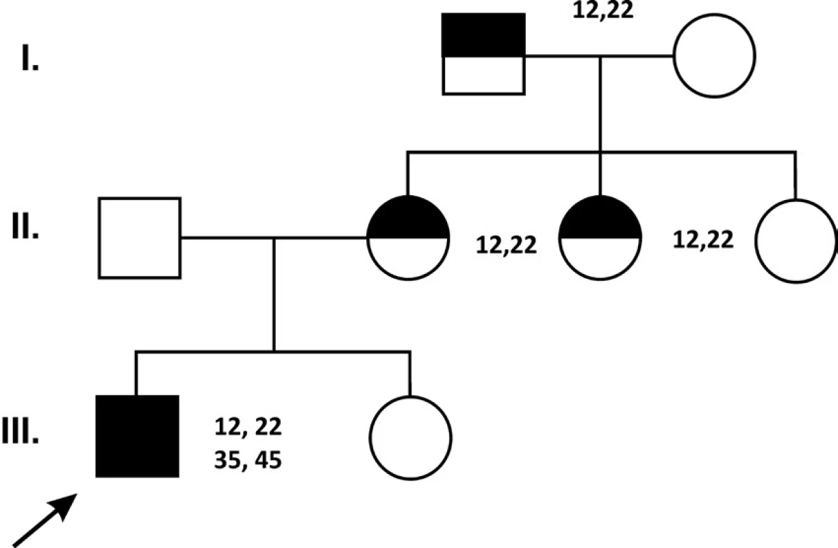 Výskyt hypodoncie horních laterálních řezáků v první a druhé generaci (12,22 – podle mezinárodní číselné identifikace zubů) spojené s hypodoncií druhých dolních premolárů (35 a 45) u probanda