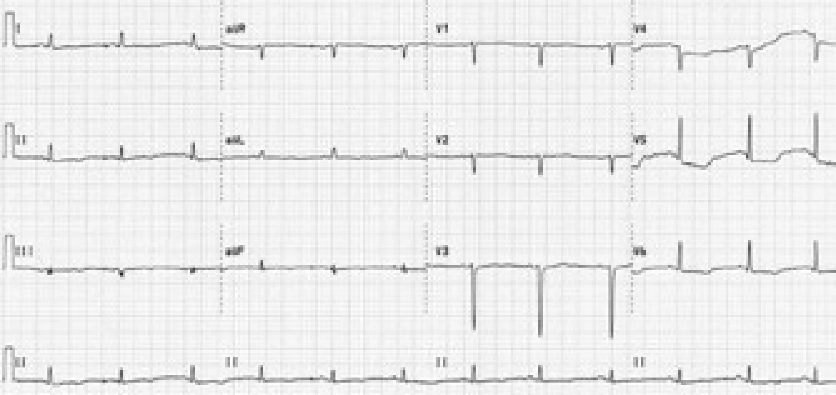 Vstupní EKG křivka. Sinusový rytmus, frekvence 90/min, osa +30°, převodní intervaly v normě, obraz rS ve V<sub>1–4</sub>, negativní P ve V<sub>1–2</sub>, descendentní deprese ST do 3 mm ve V<sub>4–6</sub>, ploše negativní vlna T diafragmaticky.